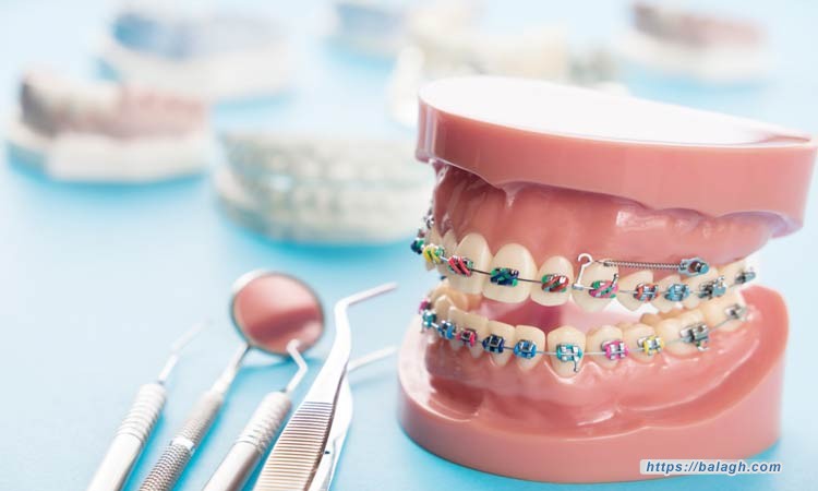 الحفاظ على تقويم الأسنان وتنظيفه