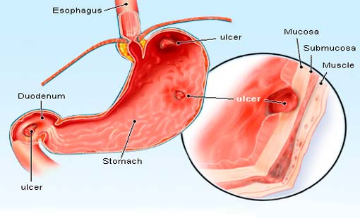القرحة الهضمية.. هاجس يؤرق الكثيرين