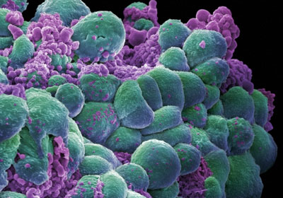 مضادات الأكسدة تعارض انتحار «خلايا السرطان»