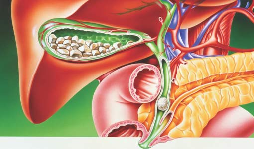 حصوات في المرارة.. أسبابها السمنة وتقدم السن