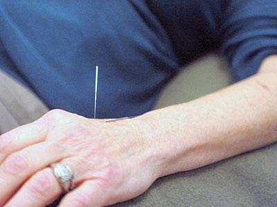 الإبر الصينية تعالج الألم المزمن