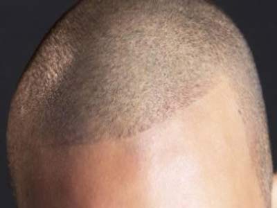 ثلاث طرق جديدة لزراعة الشعر