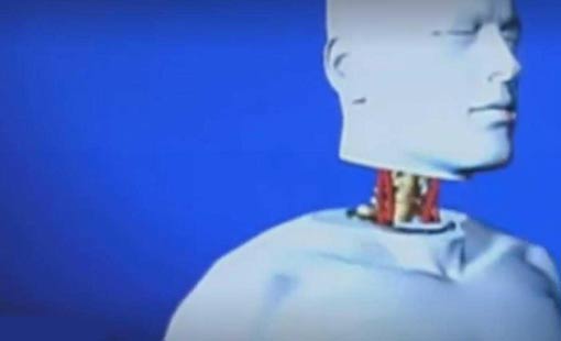 تغيير كبير في أول عملية زراعة رأس بالعالم