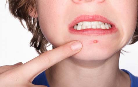 العناية بالجلد والتخلص من حب الشباب