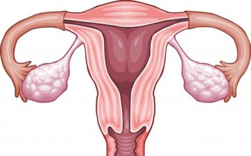 سرطان المبيض يمكن أن يقتلك بصمت