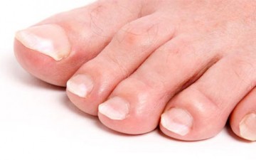 أسباب بقع الأظافر والوقاية منها