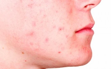 أسئلة حول حب الشباب