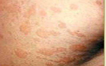 نصائح للحد من نمو الفطريات الجلدية في فصل الصيف