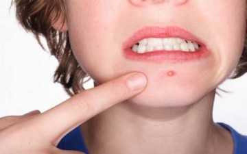 العناية بالجلد والتخلص من حب الشباب